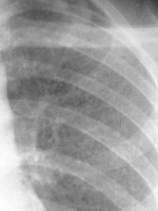 G:\photos\infection\Tuberculosis\TB cavitary with miliary spread\DSCN0024(7).JPG
